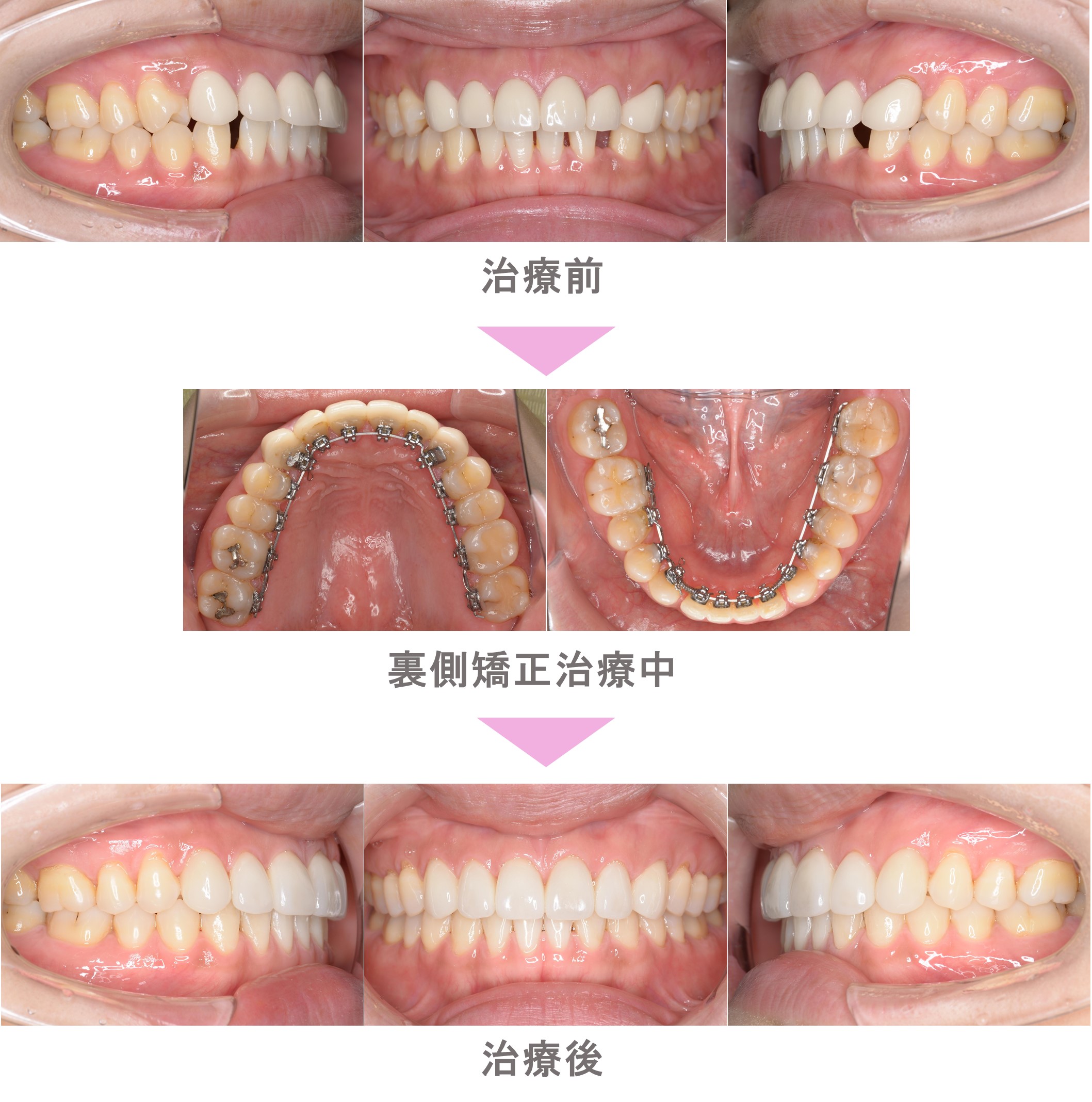 裏側矯正（舌側矯正）の症例紹介｜すきっ歯（空隙歯列）の症状｜非抜歯 