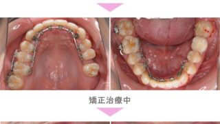 裏側矯正（舌側矯正）の症例紹介｜すきっ歯（空隙歯列）の症状｜非抜歯