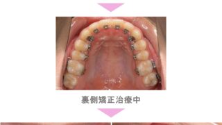裏側矯正（舌側矯正）の症例紹介｜すきっ歯（空隙歯列）の症状｜非抜歯