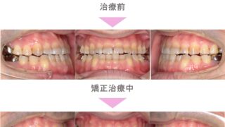 よ*ん様 反対咬合　マウスピース　S 反対咬合のマウスピース型矯正装置（インビザライン）症例②