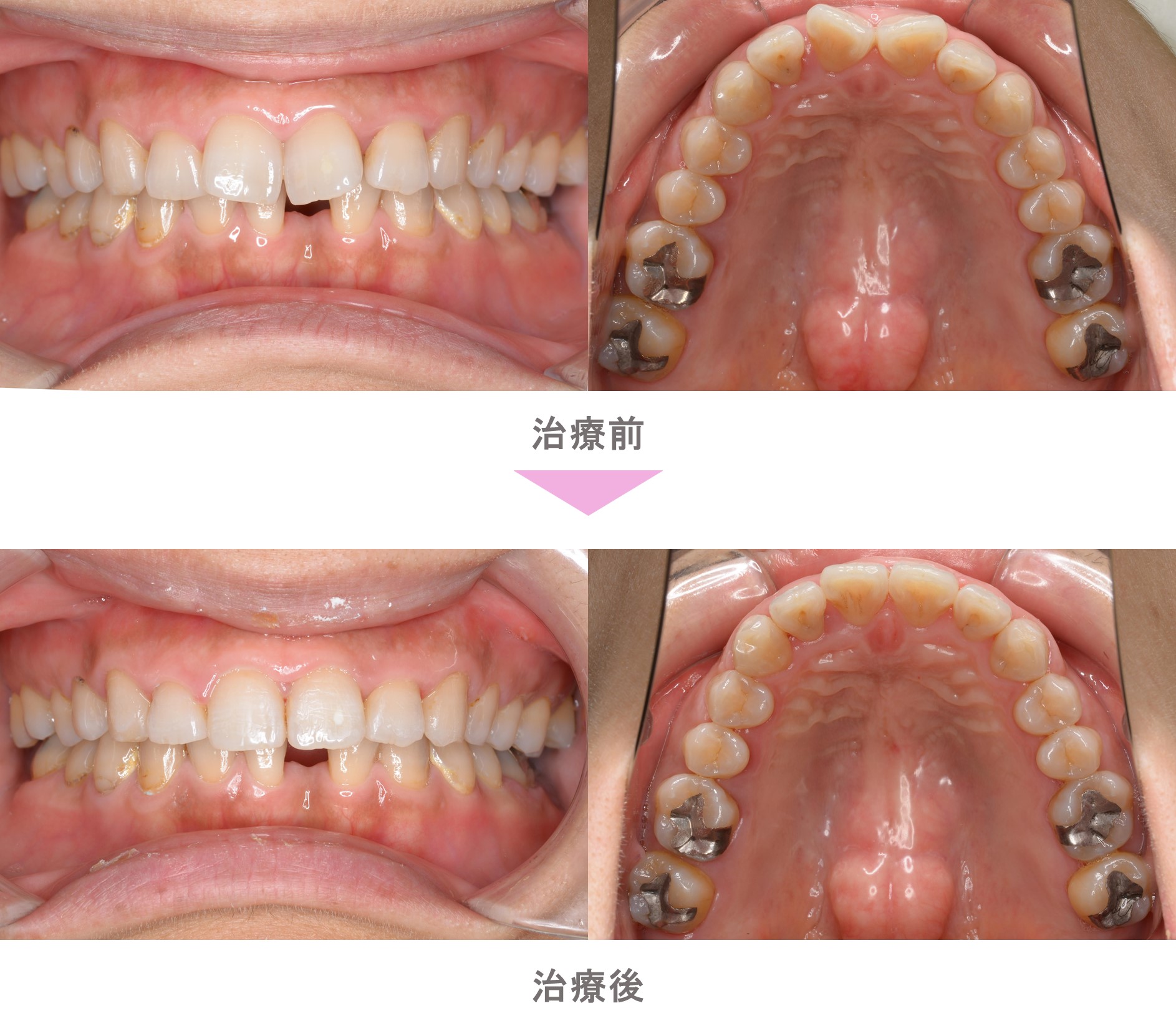 部分矯正 裏側矯正 舌側矯正 前歯のでこぼこ 非抜歯 治療期間6か月 世田谷区 ３０代女性 インビザライン矯正 裏側矯正 なら二子玉川 スマイル さくらい歯列矯正歯科 世田谷区二子玉川の矯正歯科