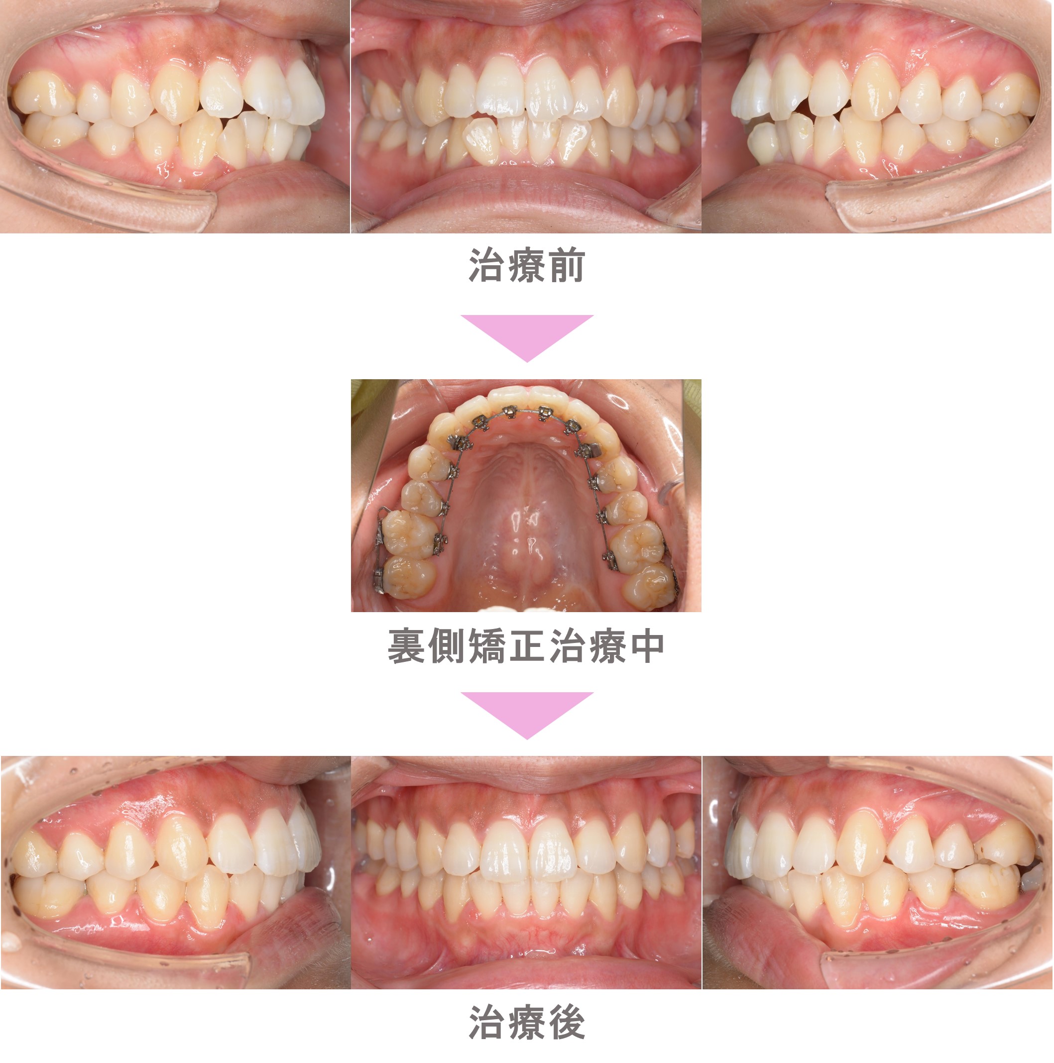 前歯の歯並びが悪い 叢生 裏側矯正 インプラント矯正 非抜歯 世田谷区 2０代女性 インビザライン矯正 裏側矯正なら二子玉川 スマイル さくらい歯列矯正歯科 世田谷区二子玉川の矯正歯科