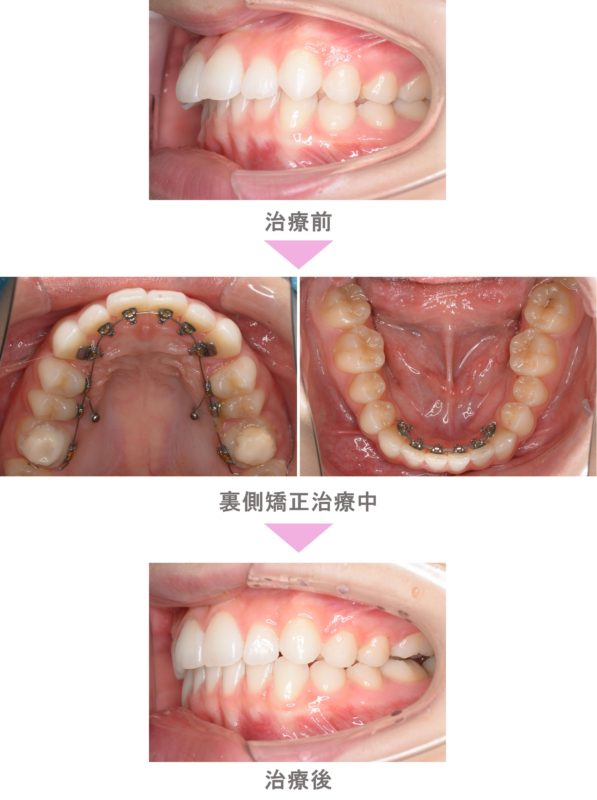部分矯正 前歯の歯並びが悪い 裏側矯正 非抜歯 治療期間2年1か月 世田谷区 大学生女性 インビザライン矯正 裏側矯正なら二子玉川 スマイル さくらい歯列矯正歯科 世田谷区二子玉川の矯正歯科