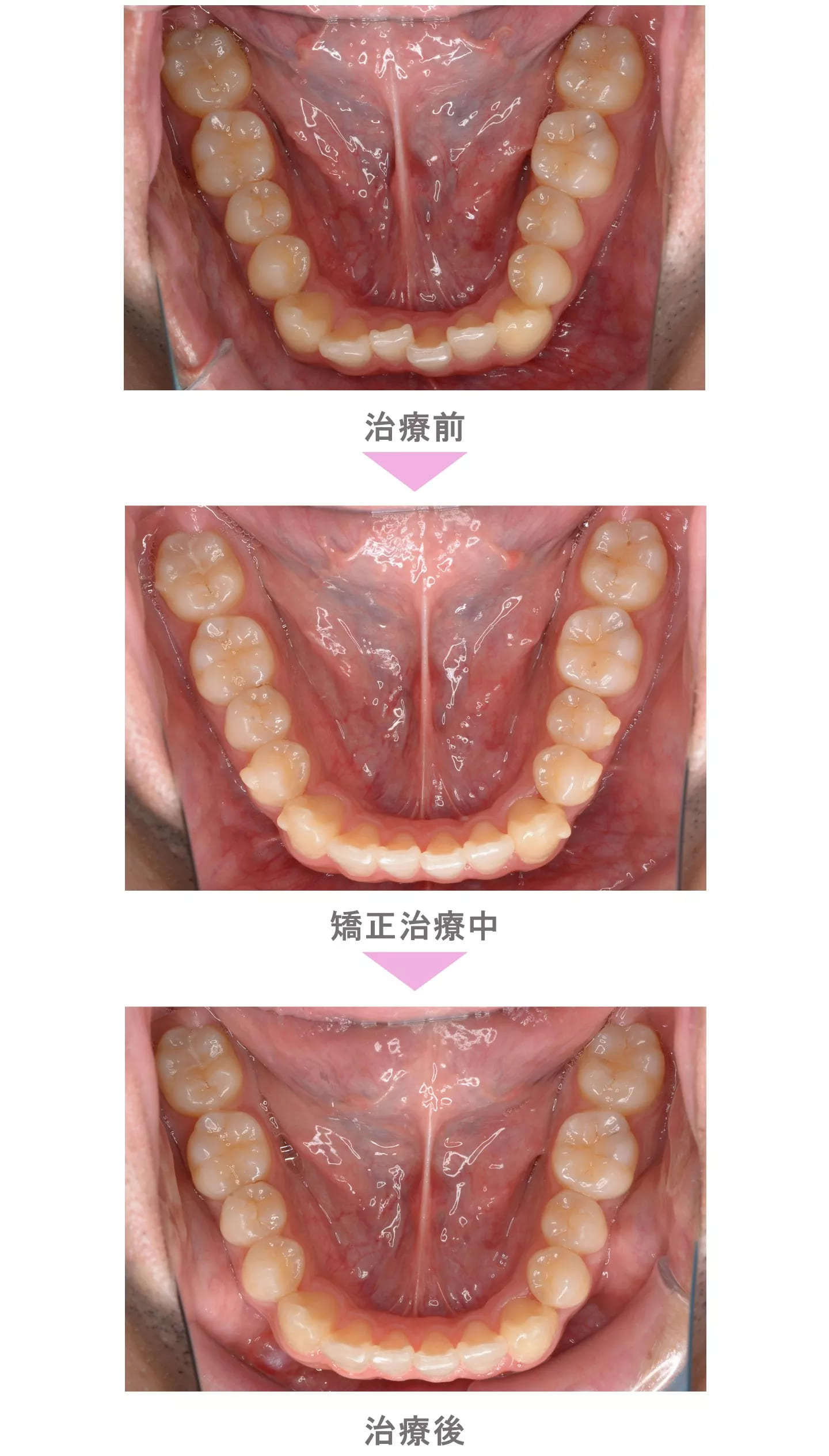 SmilePro インビザライン 歯科矯正 振動加速装置 | nate-hospital.com