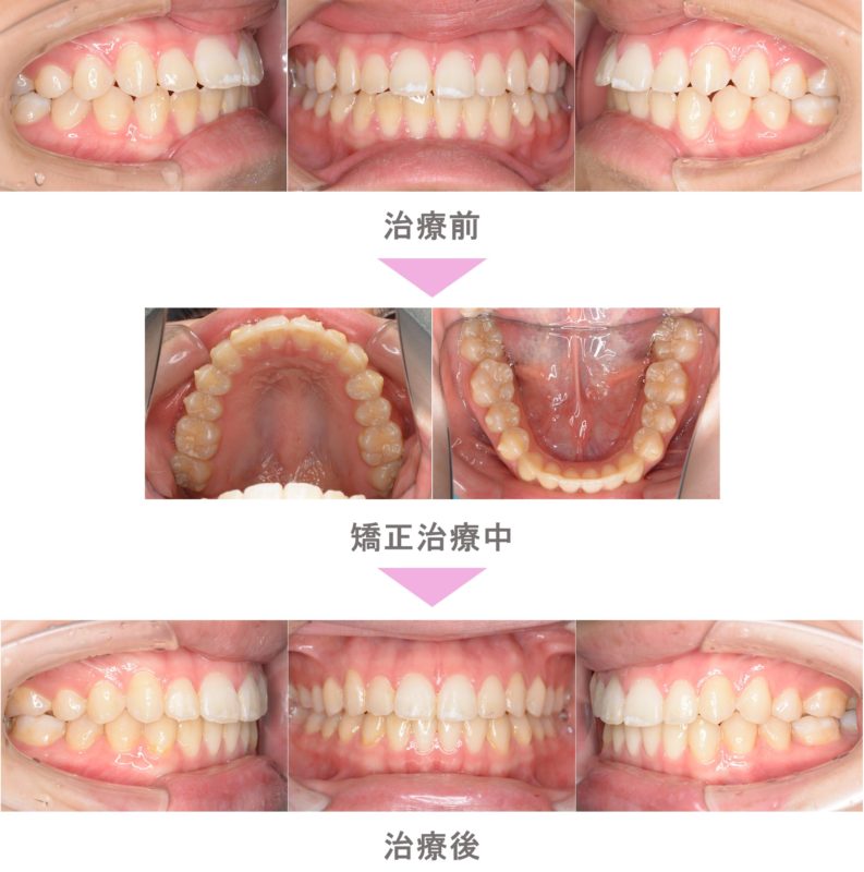 SmilePro インビザライン 歯科矯正 振動加速装置 | nate-hospital.com