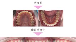 インビザライン矯正(マウスピース矯正)の症例紹介|叢生(前歯 インビザライン矯正(マウスピース矯正)の症例紹介|叢生(前歯