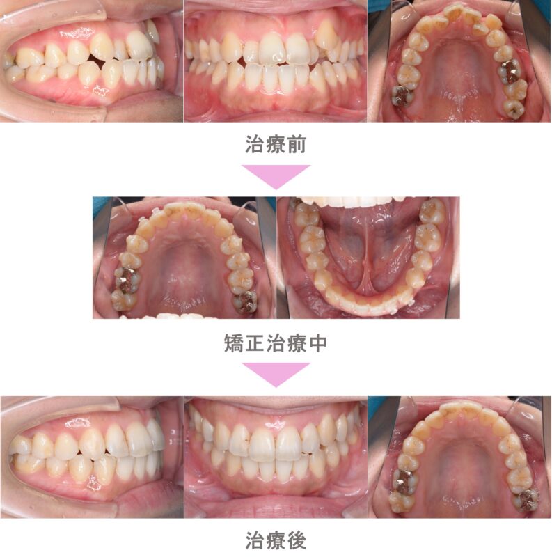 受け口（反対咬合） | 二子玉川でインビザライン矯正・裏側矯正なら