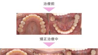 よ*ん様 反対咬合　マウスピース　S 反対咬合/下顎前突（受け口）について - 仙台一番町アーケード