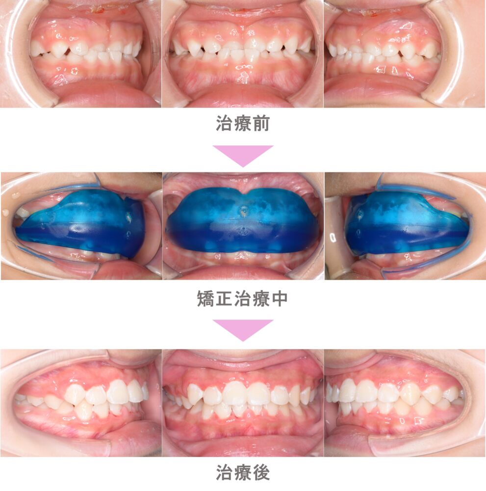 プレオルソ（予防矯正）の症例紹介｜受け口（反対咬合）の症状｜非抜歯による矯正治療｜治療期間は1年（世田谷区・5歳男児 ） | インビザライン・裏側矯正 なら「スマイル＋さくらい歯列矯正歯科二子玉川」｜世田谷区