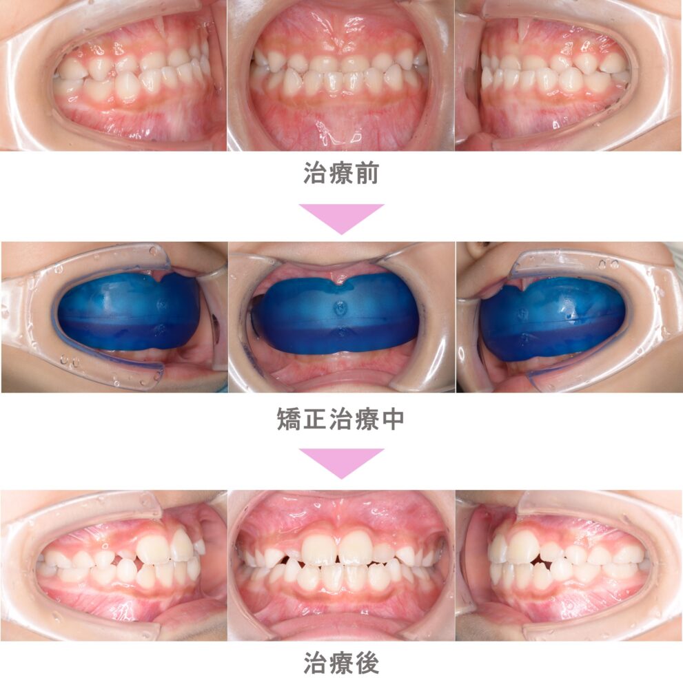 プレオルソ（予防矯正）の症例紹介｜受け口（反対咬合）の症状｜非抜歯による矯正治療｜治療期間は2年（川崎市・3歳男児 ） | インビザライン・裏側矯正 なら二子玉川「スマイル＋さくらい歯列矯正歯科」｜世田谷区